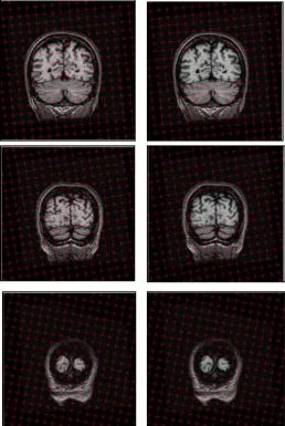 Fig 3.4. Illustration of Intracranial volume measurement using Cavalieri method with 