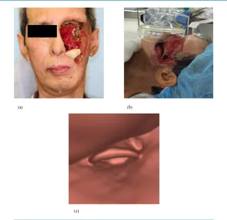 Figure 1. Large ulcerated wound on the left side of the face (a), difficult mask ventilation (b), and three-dimensional computed tomography (3D-CT) of the airway (c)