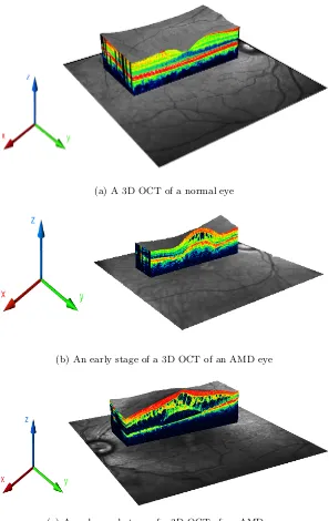 Figure 3.6: Examples of 3D OCT images from the RLUH data set used in this thesis showingthe diﬀerence between a “normal” and an AMD retina.