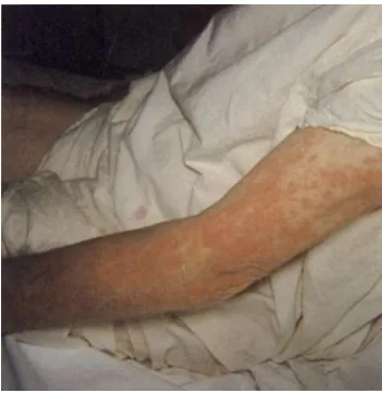 Figure 1.8 Maculopapular rash from exposure to Ampicillin (Fellner, 1986).  