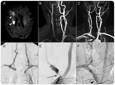 Figure 1MRI, magnetic resonance angiography (MRA), and digital subtraction angiography (DSA) imaging