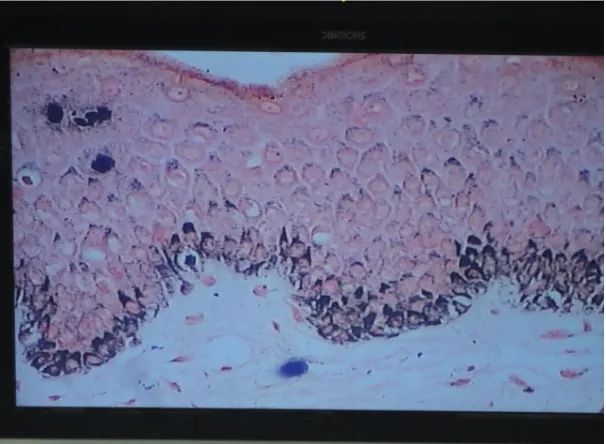 Figure 3. Fontana-Masson stained section showing basal hyperpigmentation and scattered melanophages in the dermis