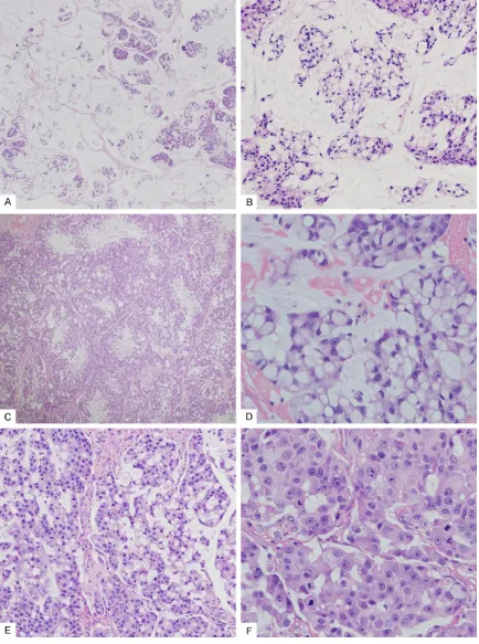Figure 2. Histopathological findings. A. Mucinous area comprising pools of mucus separated into compartments by floated in the pools of mucin, a pattern that mimicked that of mucinous adenocarcinoma (colloid carcinoma)