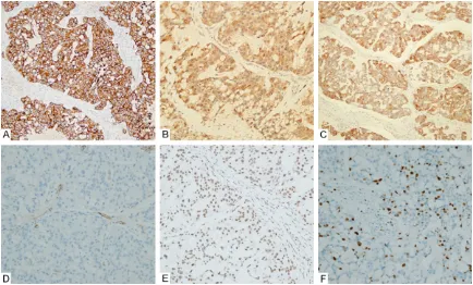 Figure 3. Immunohistochemical findings. A. The tumor cells were diffusely immunoreactivity for CK7 (×100)