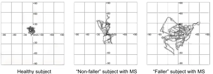 Figure 3 Statokinesigrams collected by one healthy volunteer, one patient who did not report any fall and one patient who reported three accidental falls within the last 3 months.Abbreviation: MS, multiple sclerosis.