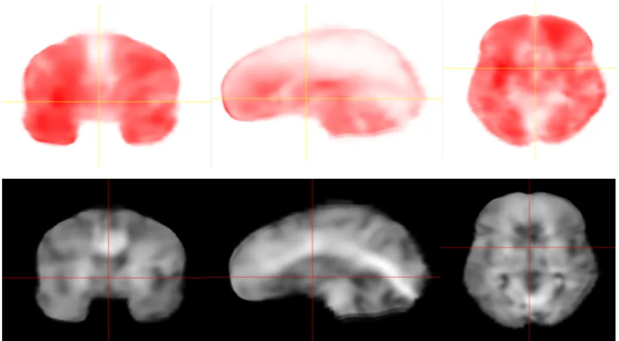 Figure 1. Distribution of Loss (top) and Storage (bottom) modulus in the FE model. Darker regionsindicate higher magnitude of shear modulus.