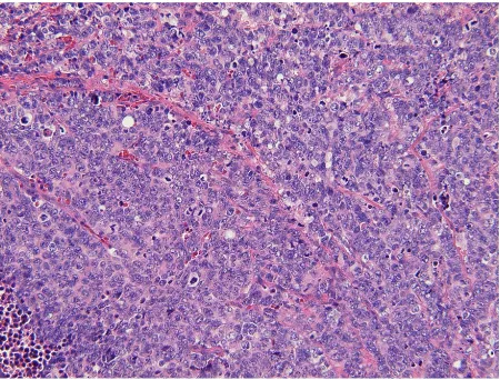 Figure 6. Pathological finding of tumor. The final pathologi-cal diagnosis was ovarian carcinoma, endometrioid adenocar-cinoma, grade 3, stage IIIb