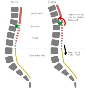 Figure 7. Postulated pathophysiological mechanism in case a TLJDH and TF coincide. Both spinal cord compression caused by the DH (green dot) and spinal cord traction (black arrow) caused by the TF (yellow line) increase with forward bending (red arrow)