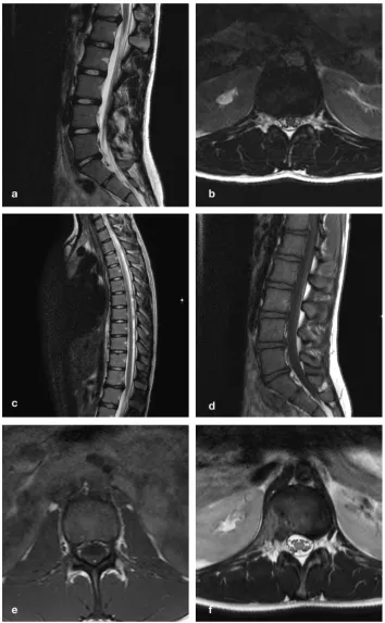 Figure 2. Sagittal (a) and axial (b) T2-weighted MR images demonstrate degenerative discopa- thy and a broad-based DH at T12-L1, impinging on the conus less than 2 cm above its termina- tion