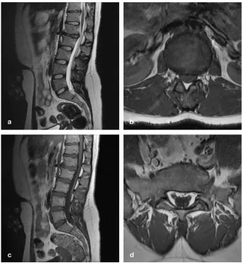 Figure 4. Sagittal T2 (a) and axial T1-weighted (b) MR images demonstrate kyphotic angula- tion and a broad-based DH at L1-L2 impinging on the conus-cauda transition