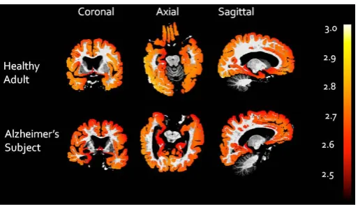 Figure 5. Local fractal values of the cortex decrease with Alzheimer’s disease. Shown are coronal, axial, and sagittal images of the brain with the local fractal dimension of the cortex superimposed