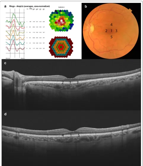 Fig. 1 Multifocal electroretinogram (a), color fundus (b) and swept‑source optical coherence tomography (SS‑OCT) horizontal (c) and vertical B-scan (d) of a healthy control patient