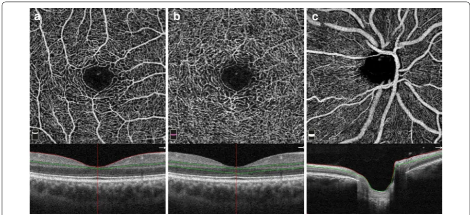 Fig. 1 a Segmentation of superficial retinal plexus with an inner boundary at 3 mm beneath the internal limiting membrane (ILM) and an outer boundary set at 15 mm beneath the inner plexiform layer (IPL)