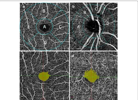 Fig. 2 a Macular sectors for VFD analysis: a fovea, b superior, c nasal, d inferior, e temporal