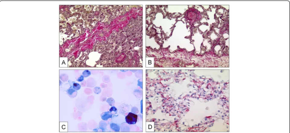 Figure 3 Pulmonary veins with obstructive venopathy in lungs of patients with PVOD and a case of pulmonary capillarydisplaying gradually different color-shades (see text)