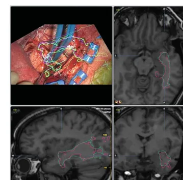 Figure 2BrainLAB display of first intraoperative image following initial dissection during right anterior