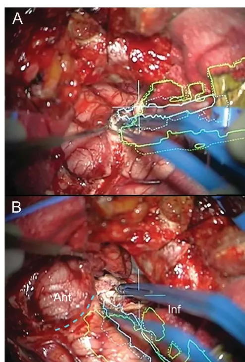 Figure 3Operating microscope display of a patient undergoing right anterior