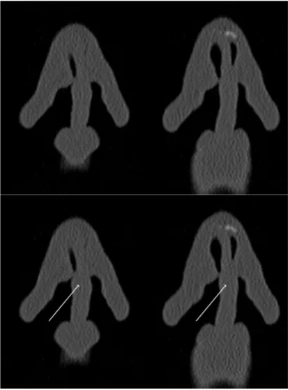Figure 1. CT scan of the nasal valve area with ULC and septum (white arrow shows the deviated septum)