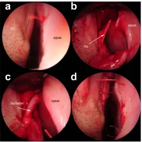 Figure 3. (a) Pre-operative endonasal situation before performing the ASF; (b) The ULC is dissected and detached from the septum; (c)The caudal part of the ULC is folded medially and fixed with a mattress suture; (d) Post-operative en-donasal situation aft