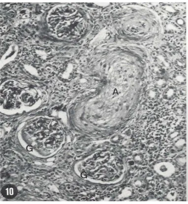 Figure 1. Necrosis of a small artery (A), necrosis of parts of two glomeruli (G), a few atrophic tubules and marked infiltration of the intestitium by monomor-phic round cells are seen (H & E, 120×)