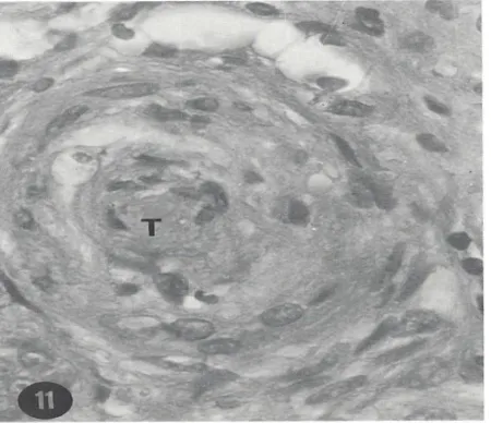 Figure 2. Hyperplasia and necrosis of smooth muscle cells and occlusion of the lumen of a large arteriole by a thrombus (T) (H & E, 320×)