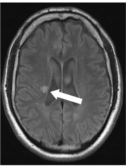 Figure 3: Lacunar infarct (arrow) on FLAIR image, axial view. 