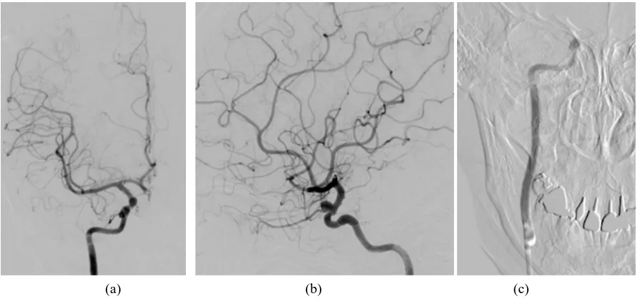 Figure 1. A right internal carotid angiogram showing an internal carotid-ophthalmic artery aneurysm in anteroposterior view (a) and in lateral view (b)