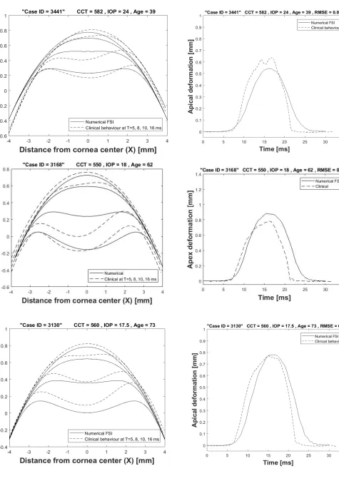 Figure 10: Spatial corneal deformation and temporal apical deformation comparison with 3 clinical cases  