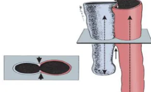 Fig 2:  Morphologic erosion 