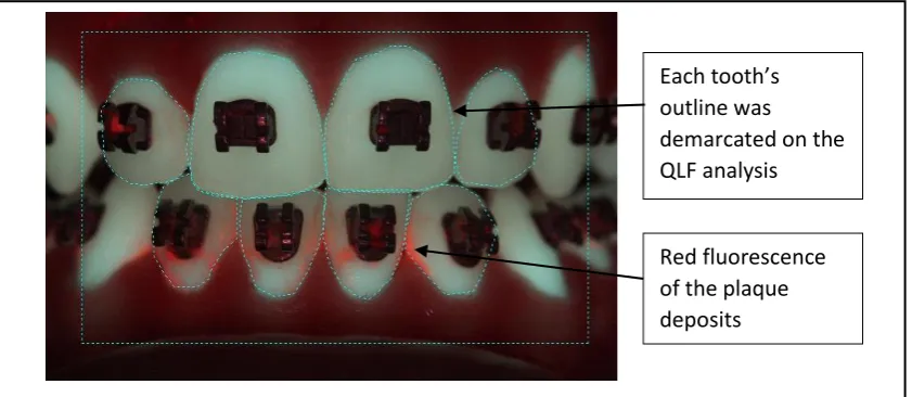 Figure 6.1: Customised computer analysis of the plaque accumulation 