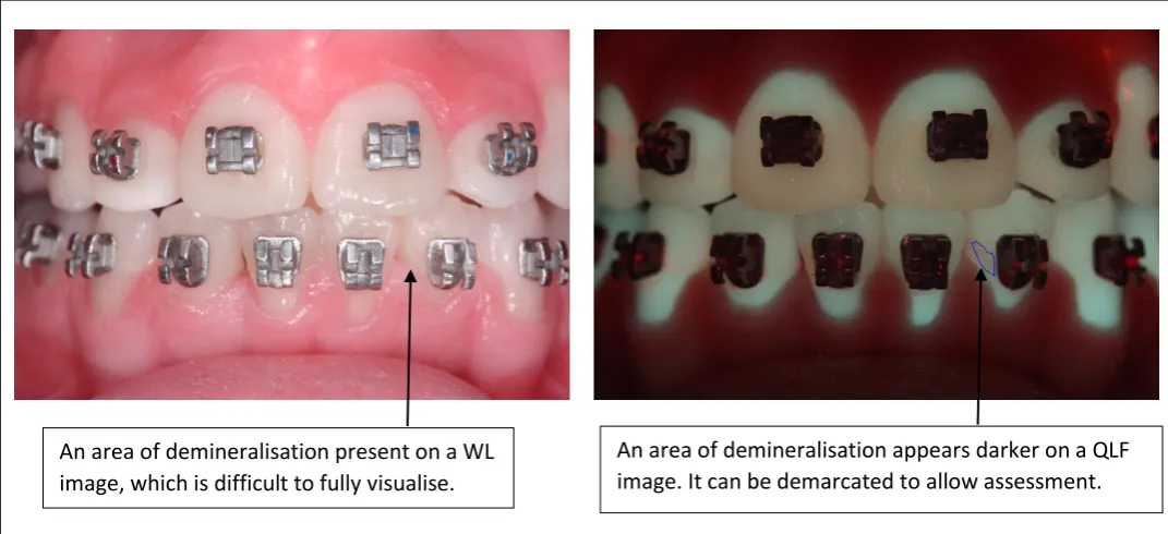 Figure 6.2: Customised computer analysis of demineralisation 
