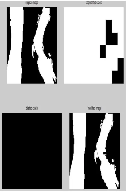 Figure 5: Exostoses X-Ray Image 