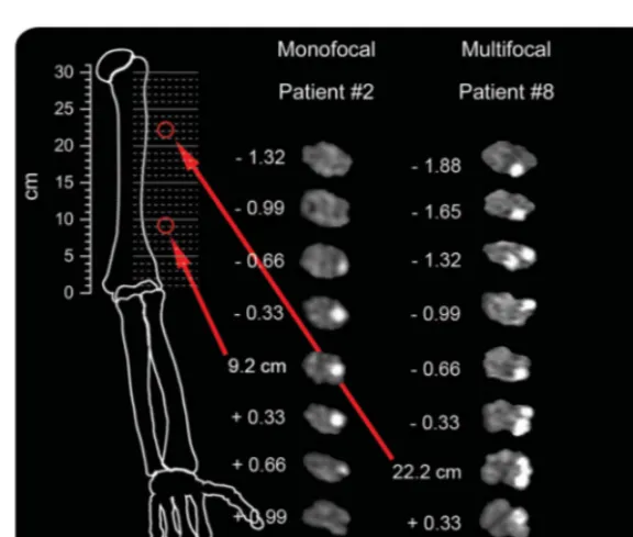 Figure 3Monofocality and multifocality as 2 principal lesion patterns of