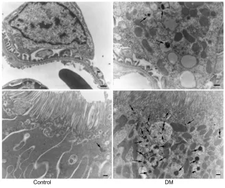 Figure 3 Pre-embedding electron microscopy for human prorenin.Notes: Black label for human prorenin was detected in podocyte vesicles and proximal tubules in diabetic rats 40 minutes after its first intravenous injection (arrows), but was barely detected i