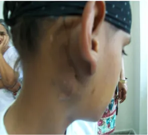 Figure 1. An operated case of Kimura’s disease presented with recurrence.         