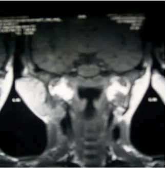 Figure 2. Computed tomographic (image of patient showing swelling upper part of neck)