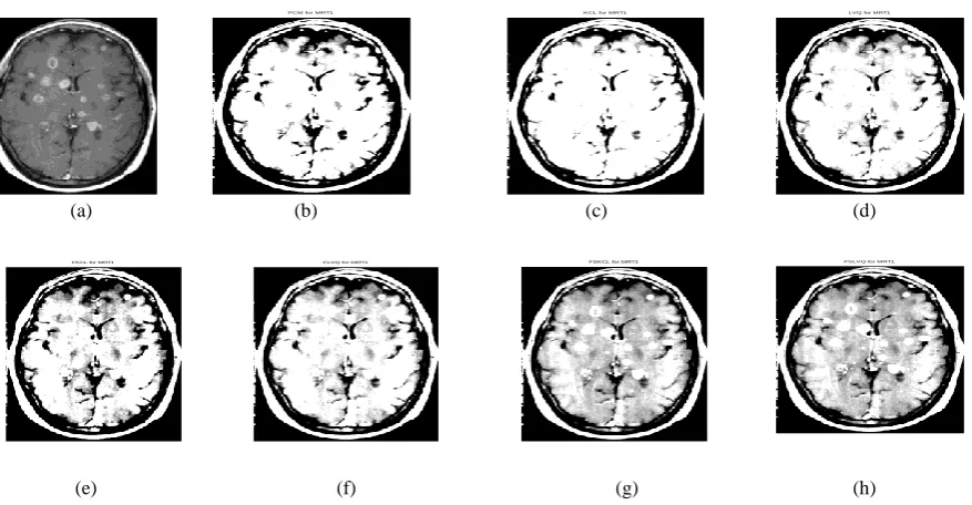Fig 1: Segmentation results for the Metsbrain MR T1 data set (a) Original image (b) FCM segmentation, (c) KCL segmentation, (d) LVQ segmentation, (e) FKCL segmentation, (f) FLVQ segmentation, (g) FSKCL segmentation and (h) FSLVQ segmentation