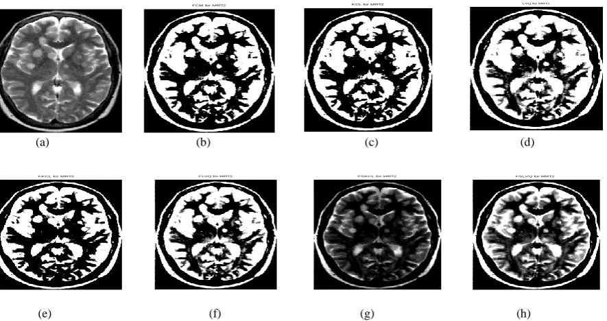 Fig 2: Segmentation results for the Metsbrain MR T2 data set (a) Original image (b) FCM segmentation, (c) KCL segmentation, (d) LVQ segmentation, (e) FKCL segmentation, (f) FLVQ segmentation, (g) FSKCL segmentation and (h) FSLVQ segmentation