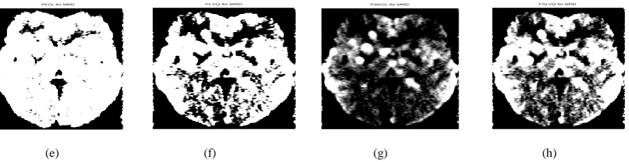 Fig 4: Segmentation results for the Metsbrain MR D data set (a) Original image (b) FCM segmentation, (c) KCL segmentation, (d) LVQ segmentation, (e) FKCL segmentation, (f) FLVQ segmentation, (g) FSKCL segmentation and (h) FSLVQ segmentation