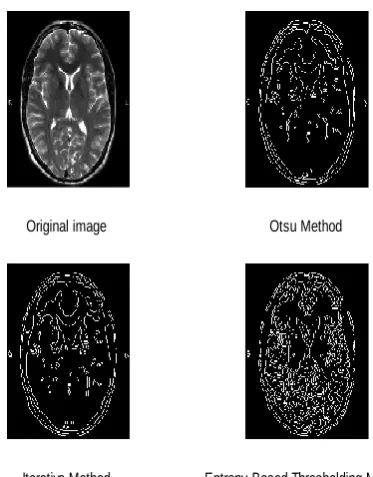 Fig 1: edge detection results by Otsu, Iterative and Entropy based methods on brain image 