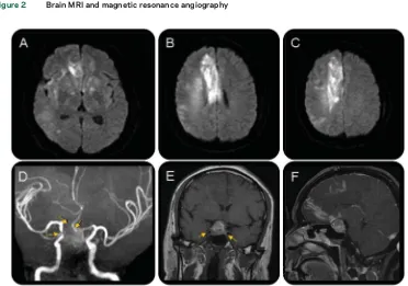 Figure 2Brain MRI and magnetic resonance angiography