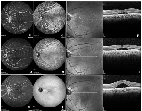 Fig. 2 Example of a chronic central serous chorioretinopathy patient who was a poor responder to PDT