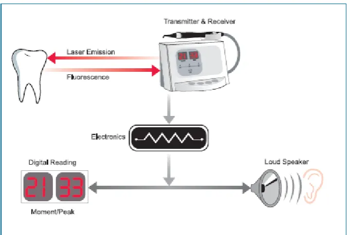 Figure 1. 5– DIAGNOdent  process of laser fluorescence detection. (Obtained from www.Kavo.com) 