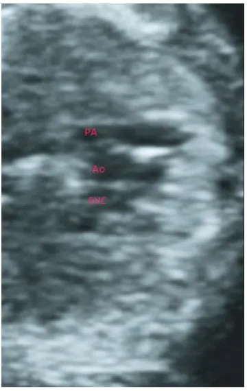 Figure 1. Transverse ultrasound image obtained using a high frequency transabdominal linear transducer showing two orbits and lens (arrows) at 12 weeks’ gestation