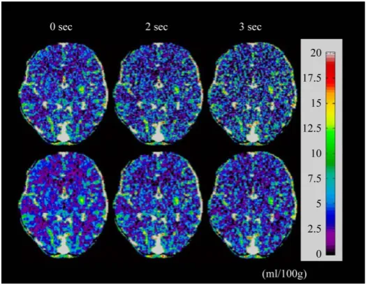 Figure 2. Typical examples of the cerebral blood flow (CBF) images generated from the original, interpolated and AD images