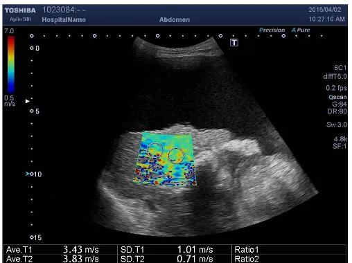 Figure 2. SWE in chronic hepatitis group.                             