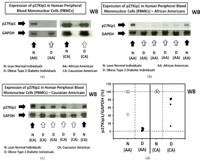 Figure 1. Expression of p27(Kip1) is significantly and, in certain cases, severely decreased in human pe-ripheral blood mononuclear cells (PBMCs) obtained from obese type 2 diabetic individuals relative to the lean normal individuals