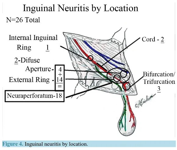 Figure 4. Inguinal neuritis by location.                                 