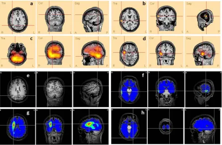 Figure S1. Comparison between the lesion (a and e) presented in patient’s #2 MRI and the ESI obtained by different methods: (b) ED, (c) LAURA, (d) CLARA, (f) BMA, (g) LORETA and (h) MN