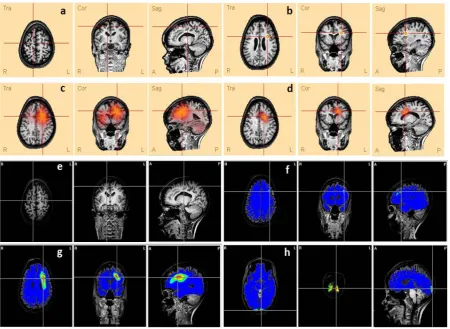 Figure 2. Score system applied for giving points based on the relation between the lesion’s location in MRI and the solutions found by ESI methods